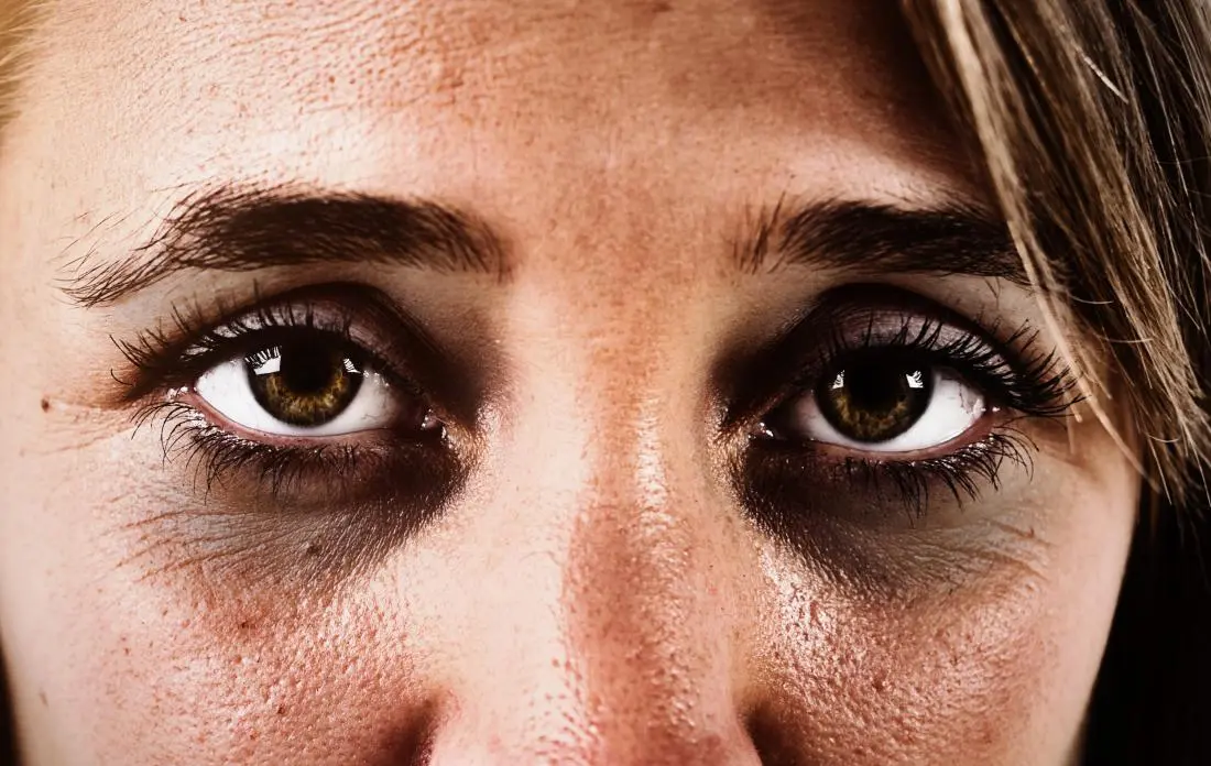 dark-circles-under-eyes